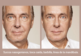 Relleno de arrugas y restauración de volúmenes