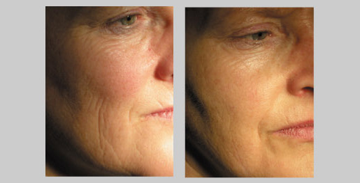 tratamiento con radio frecuencia