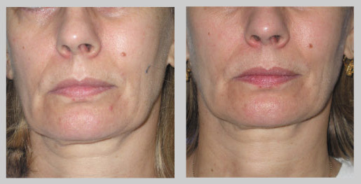 tratamiento con radio frecuencia