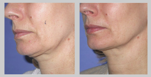 tratamiento con radio frecuencia