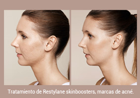 Tratamiento con skinboosters